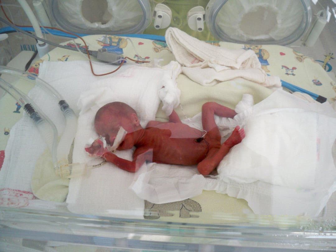 Low birth weight - Wikipedia
