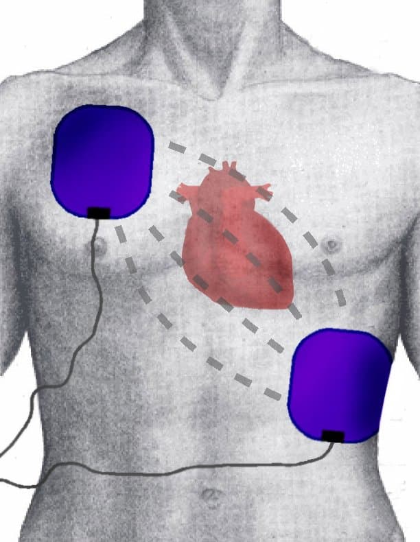 Défibrillation — Wikipédia