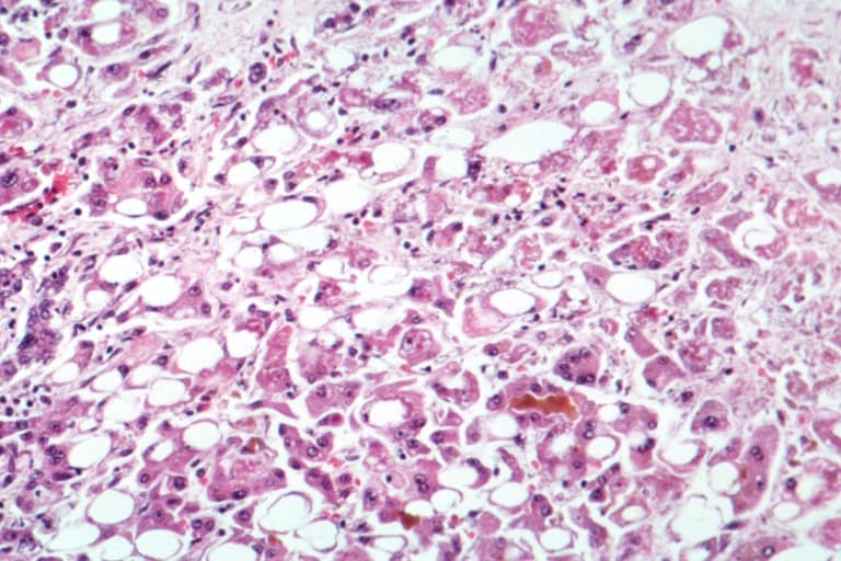 Alcoholic liver disease - Wikipedia