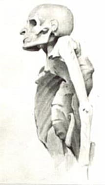 Mal de Pott — Wikipédia