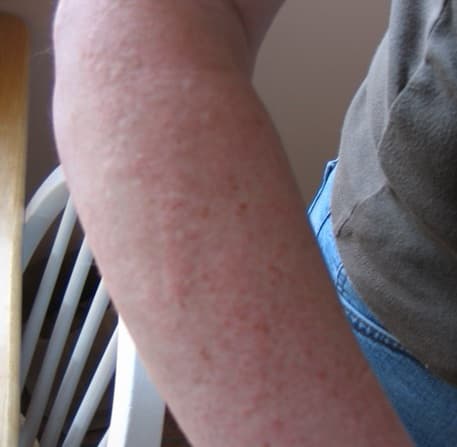 Lumière intense pulsée — Wikipédia