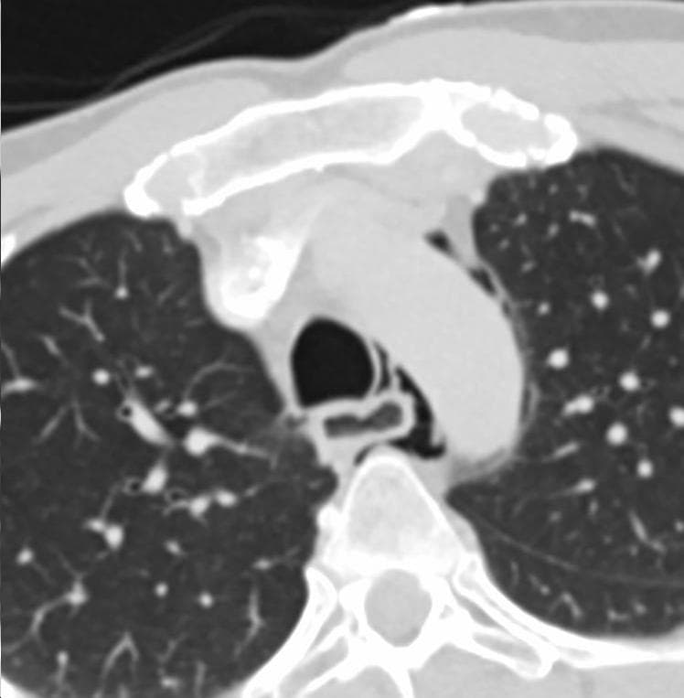 Esophageal rupture - Wikipedia