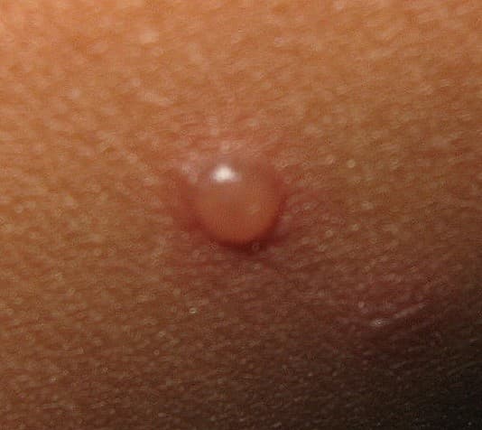 Sérosité — Wikipédia