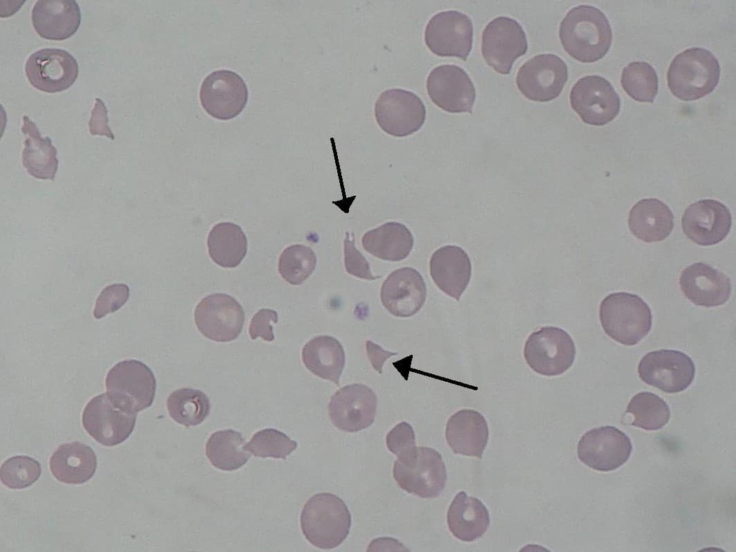 Microangiopathie thrombotique — Wikipédia