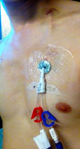Hickman line - Wikipedia