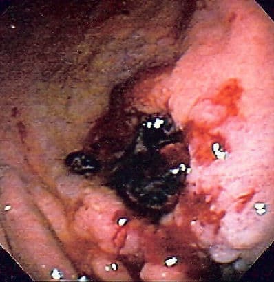 Gastrointestinal bleeding - Wikipedia