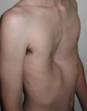 Pectus excavatum - Wikipedia