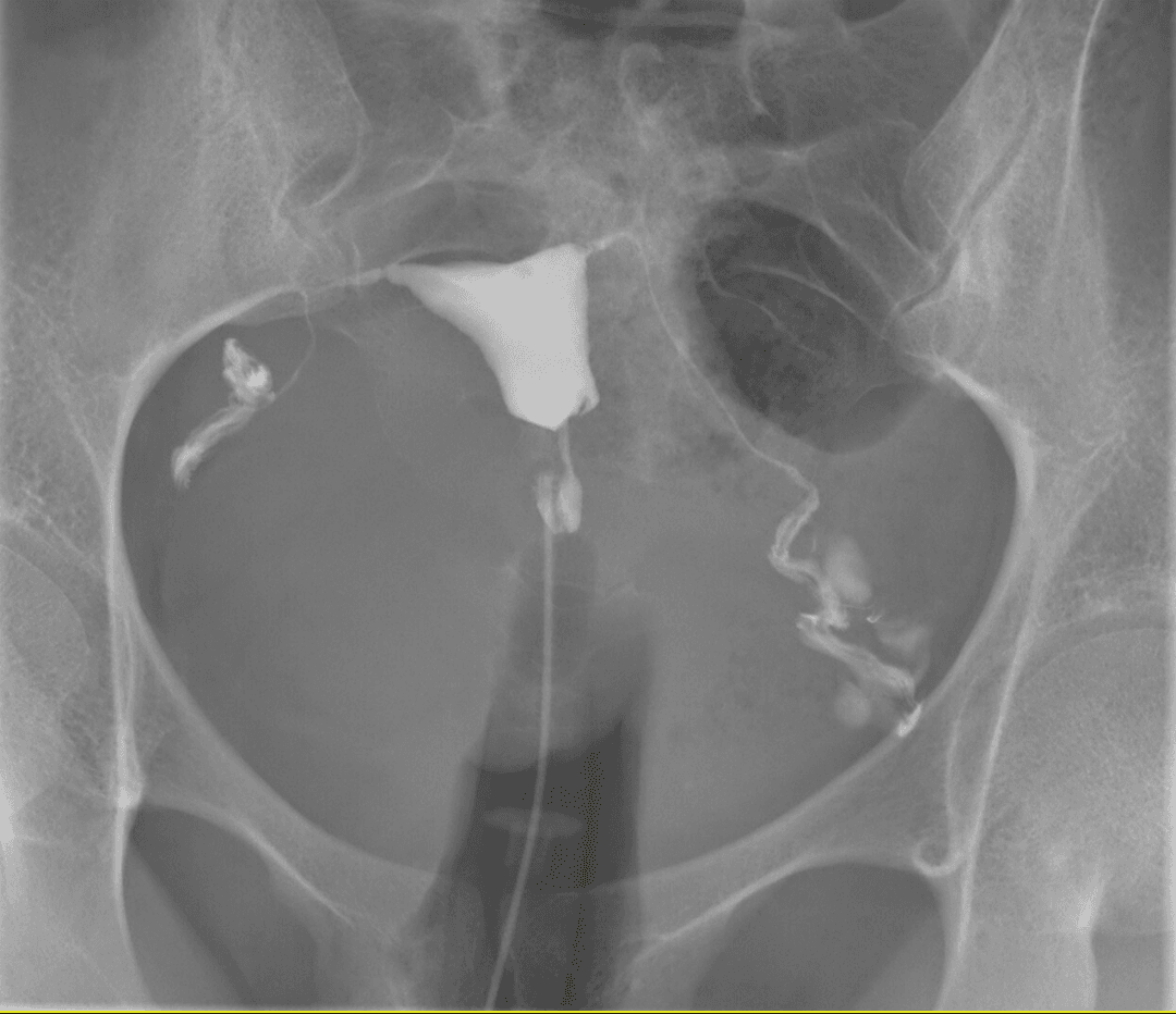 Hysterosalpingography - Wikipedia