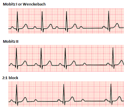 Second-degree atrioventricular block - Wikipedia
