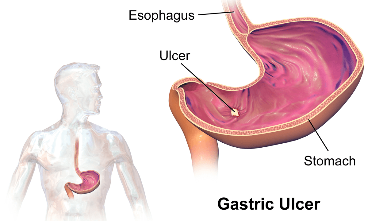 Peptic ulcer disease - Wikipedia