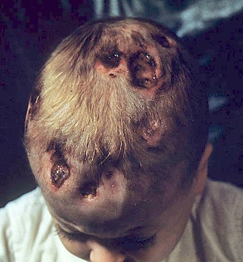 Histiocytose langerhansienne — Wikipédia