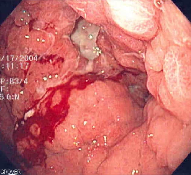 Stomach cancer - Wikipedia