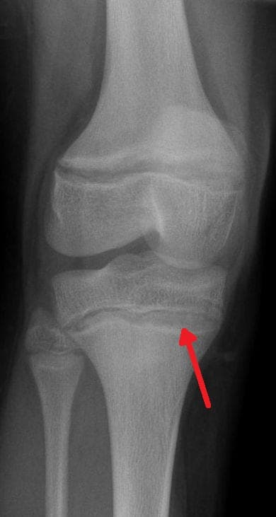 Saturnisme — Wikipédia