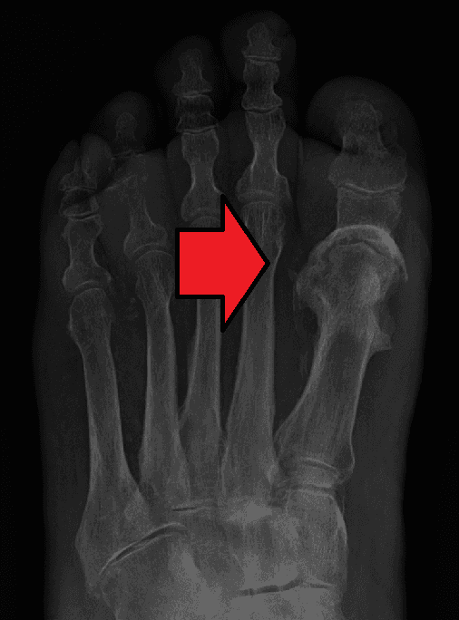 Osteomyelitis - Wikipedia