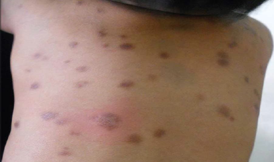 Lesion - Wikipedia