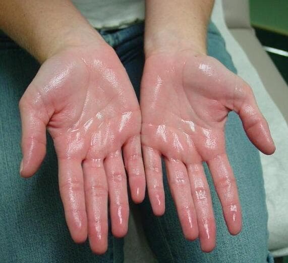 Hyperhidrosis - Wikipedia
