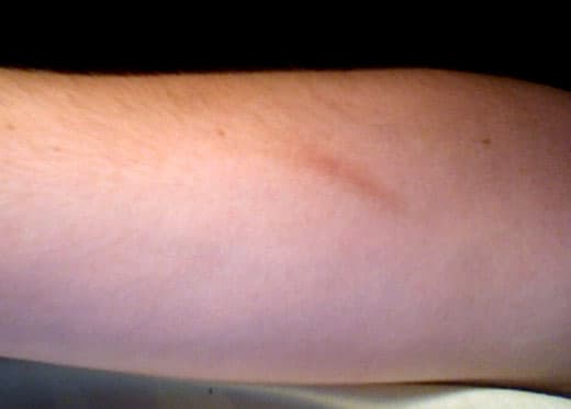 Cicatrice — Wikipédia