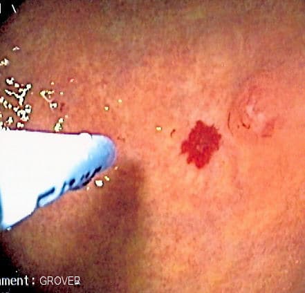 Angiodysplasie — Wikipédia