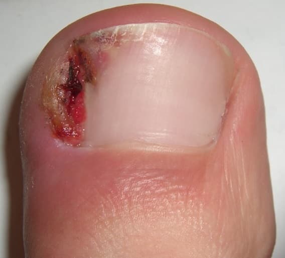 Ingrown nail - Wikipedia