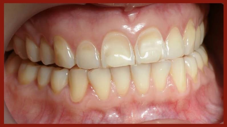 Dental erosion - Wikipedia