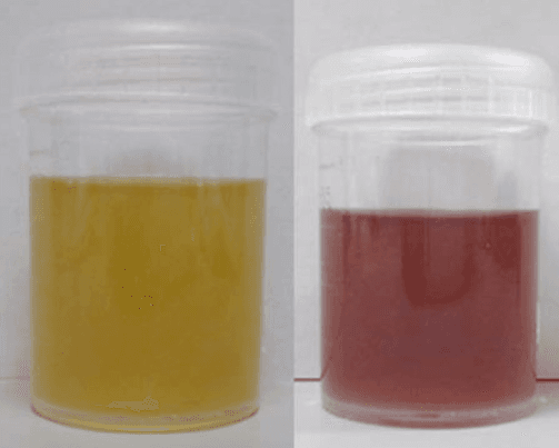 Porphyria - Wikipedia