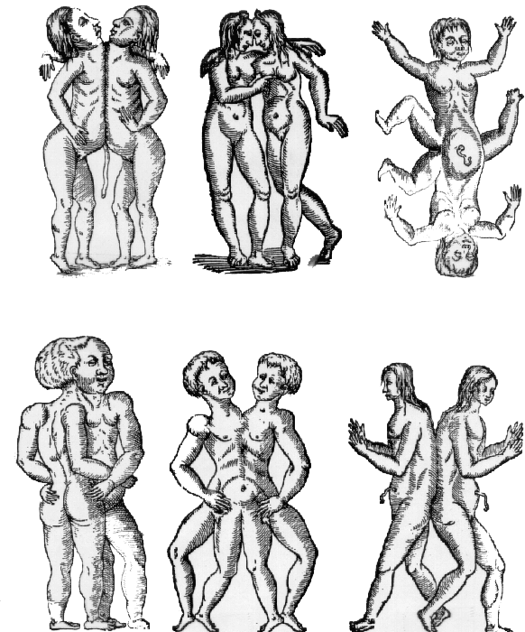 Jumeaux siamois — Wikipédia