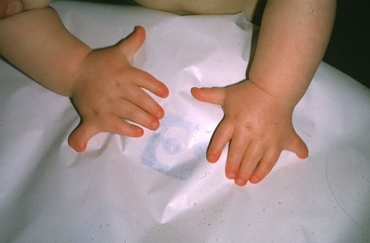 Polydactylie — Wikipédia