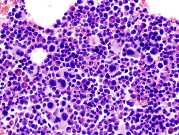 Thrombocytémie essentielle — Wikipédia