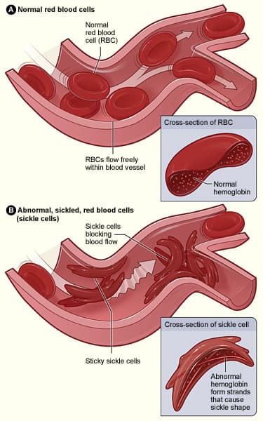 Sickle cell disease - Wikipedia