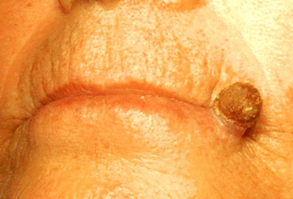 Kératose actinique — Wikipédia