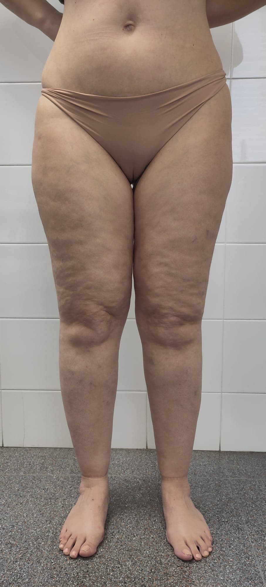 Lipedema - Wikipedia