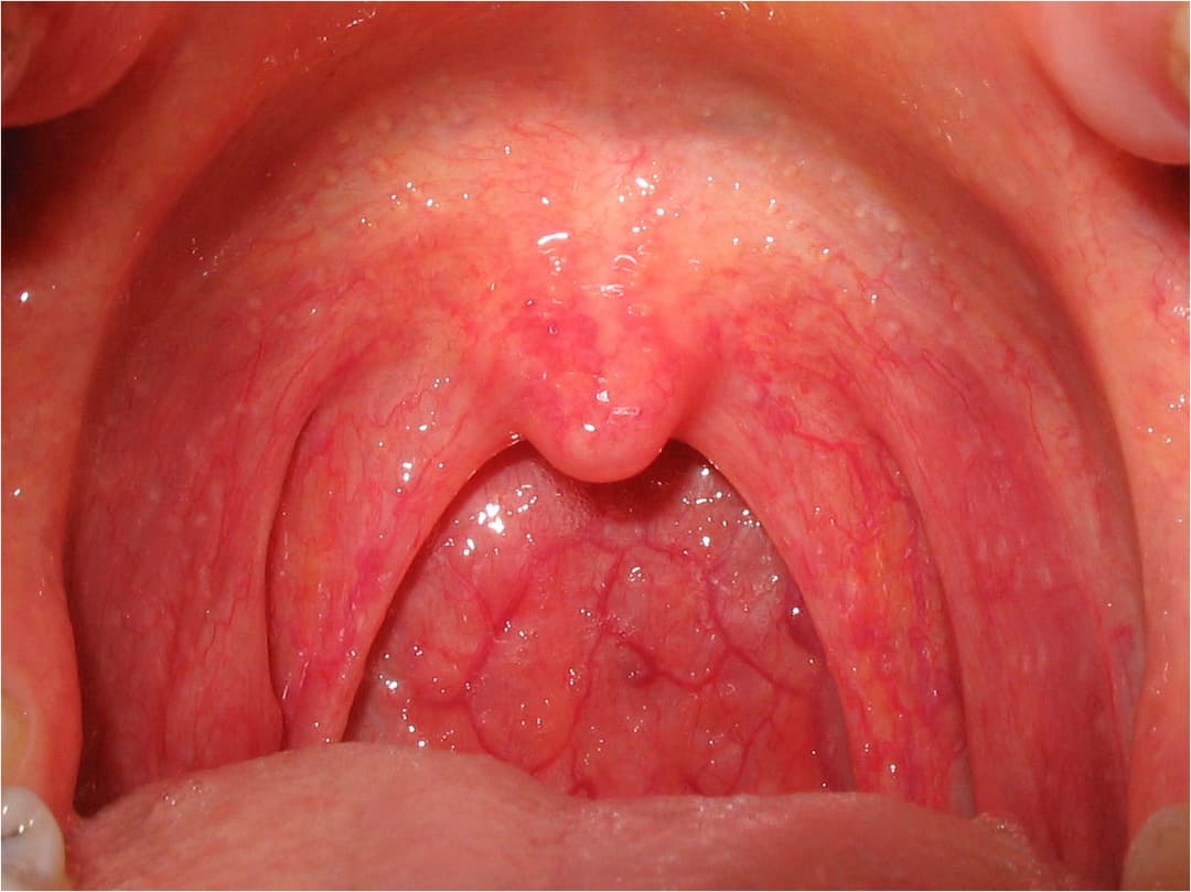 Pharyngitis - Wikipedia