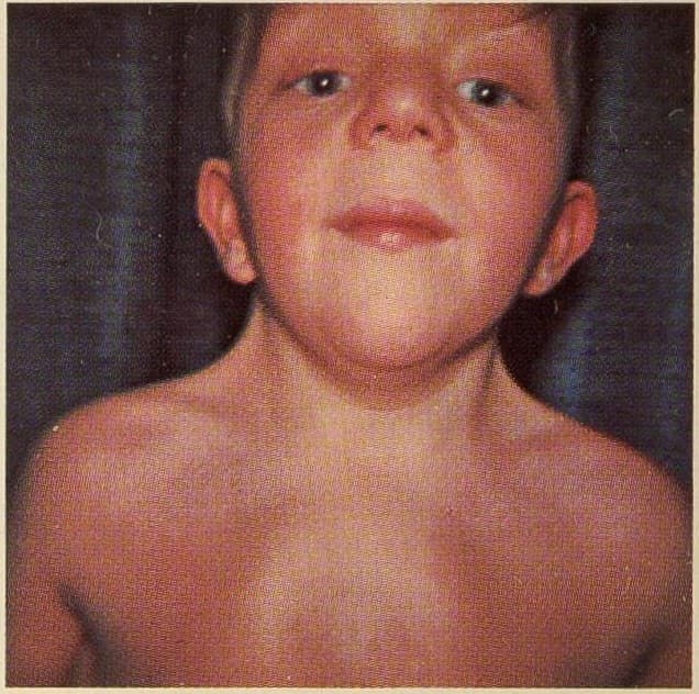 Noonan syndrome - Wikipedia