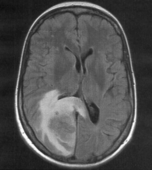 Cerebral edema - Wikipedia