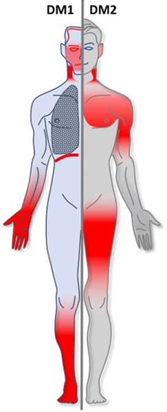 Myotonic dystrophy - Wikipedia