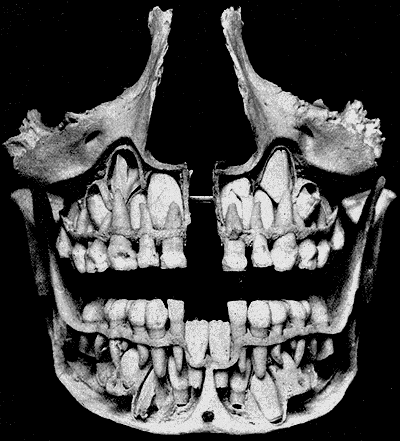 Tooth eruption - Wikipedia