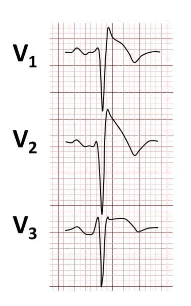 Brugada syndrome - Wikipedia