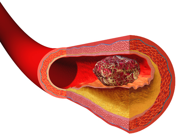 Thrombosis prevention - Wikipedia