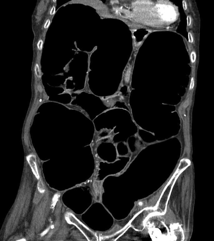 Intestinal pseudo-obstruction - Wikipedia