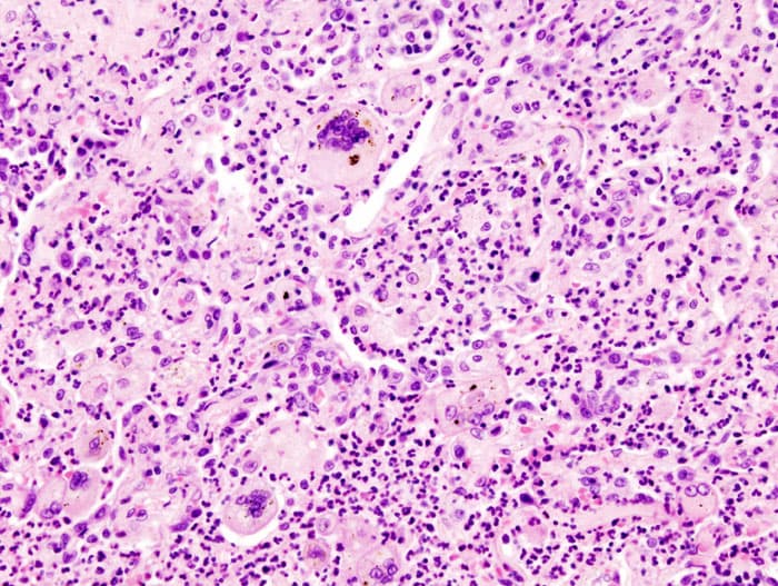 Aspiration pneumonia - Wikipedia