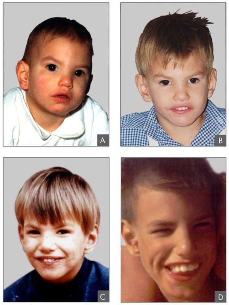 Cri du chat syndrome - Wikipedia