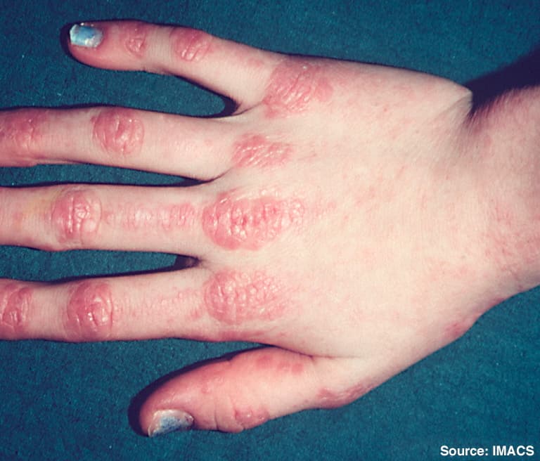 Dermatomyositis - Wikipedia