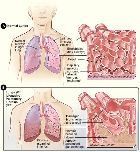 Fibrose pulmonaire idiopathique — Wikipédia