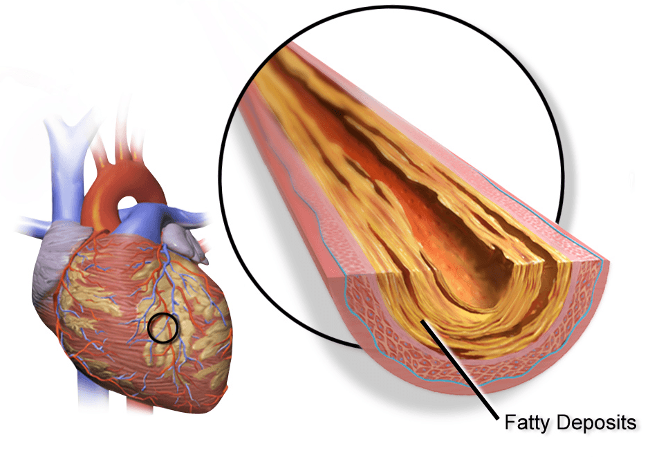 Atherosclerosis - Wikipedia