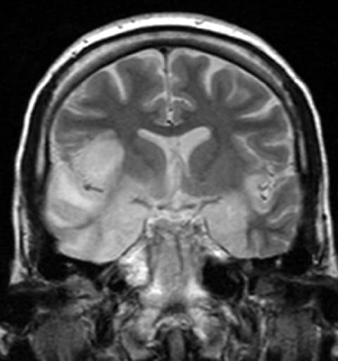 Encephalitis - Wikipedia