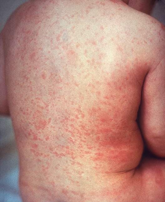 Rubella - Wikipedia
