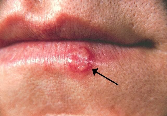 Herpes - Wikipedia