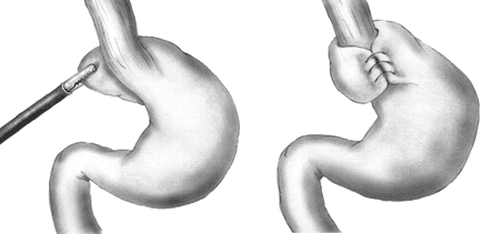 Fundoplicature de Nissen — Wikipédia