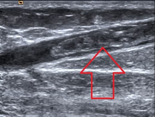 Superficial vein thrombosis - Wikipedia
