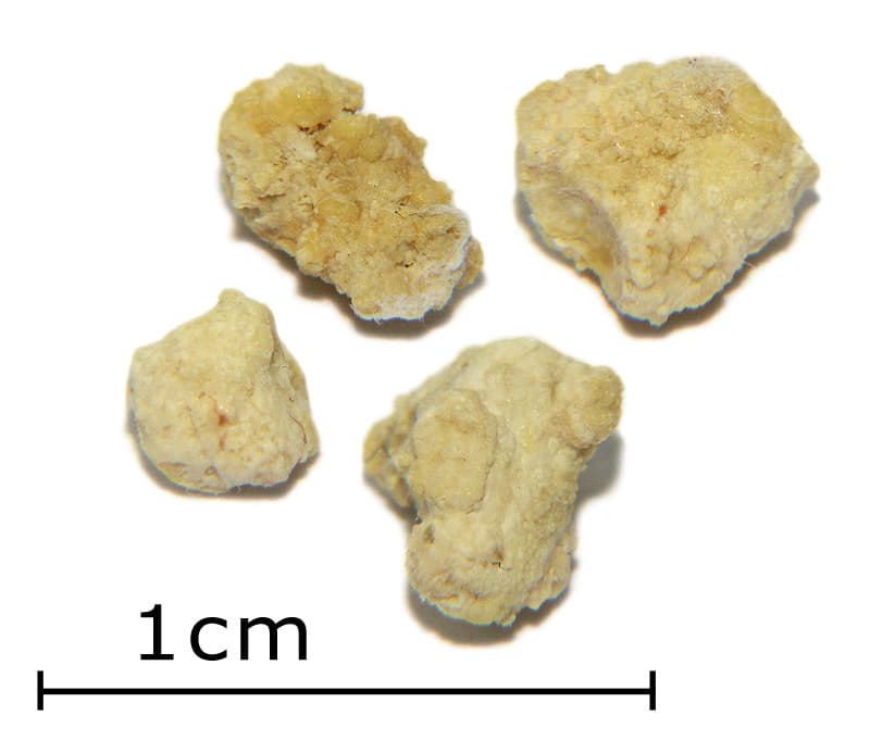Lithiase salivaire — Wikipédia